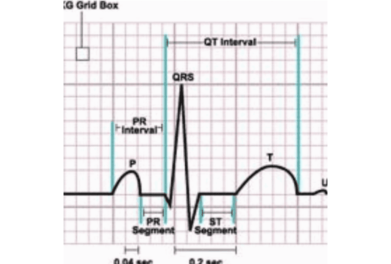 Electrocardiogram showing P wave, QRS complex, and T wave with intervals and segments labeled.