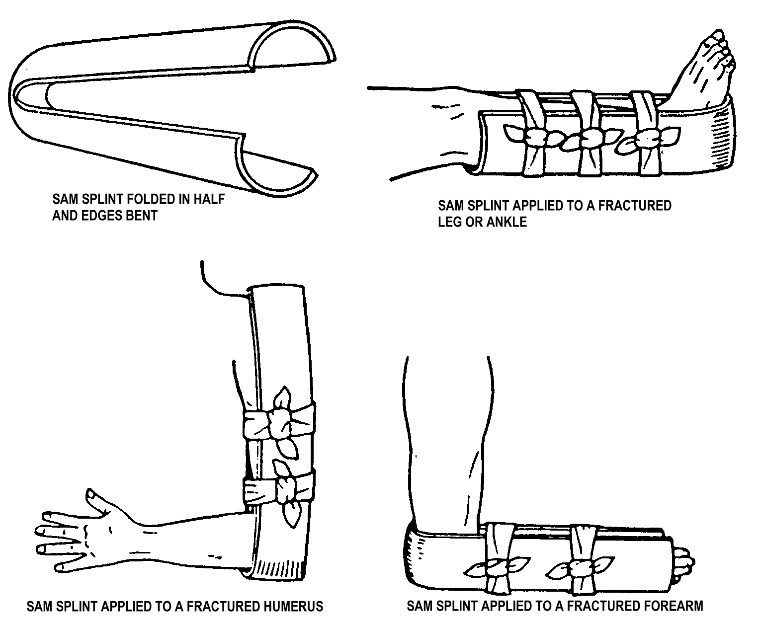 Splinting Skeleton SPLINTING - Onsite Medical Training